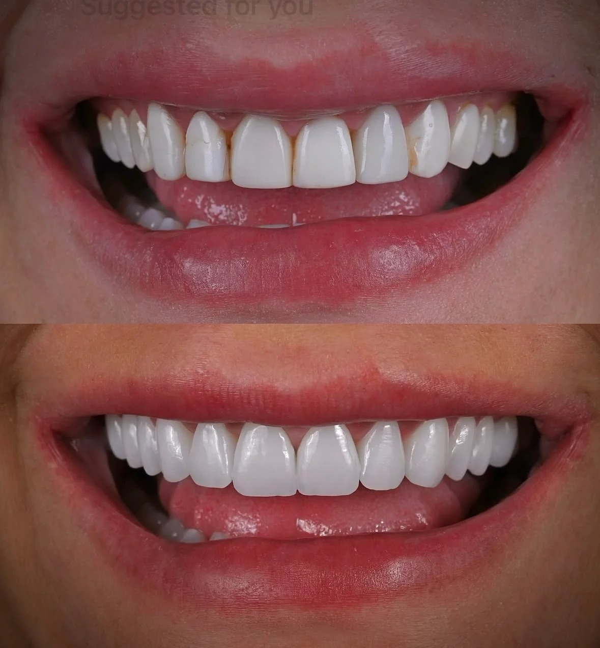 Veneer result